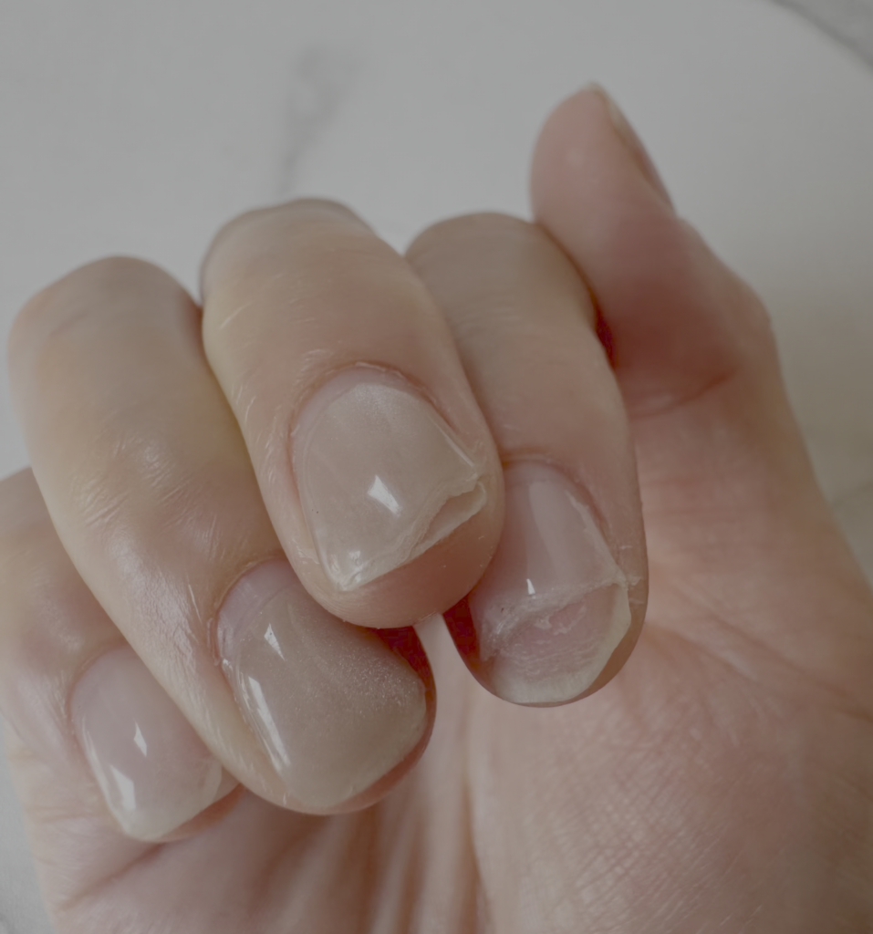 Nail Lifting Caused by Excessive Top Coat Hardness